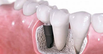 Est-ce que les implants dentaires sont faits pour vous? prothèses sur implants Gatineau