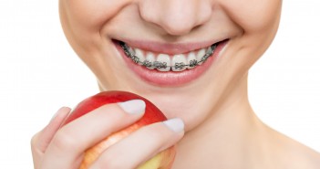 An Alternative Method of Fixing Crooked Teeth brackets on teeth