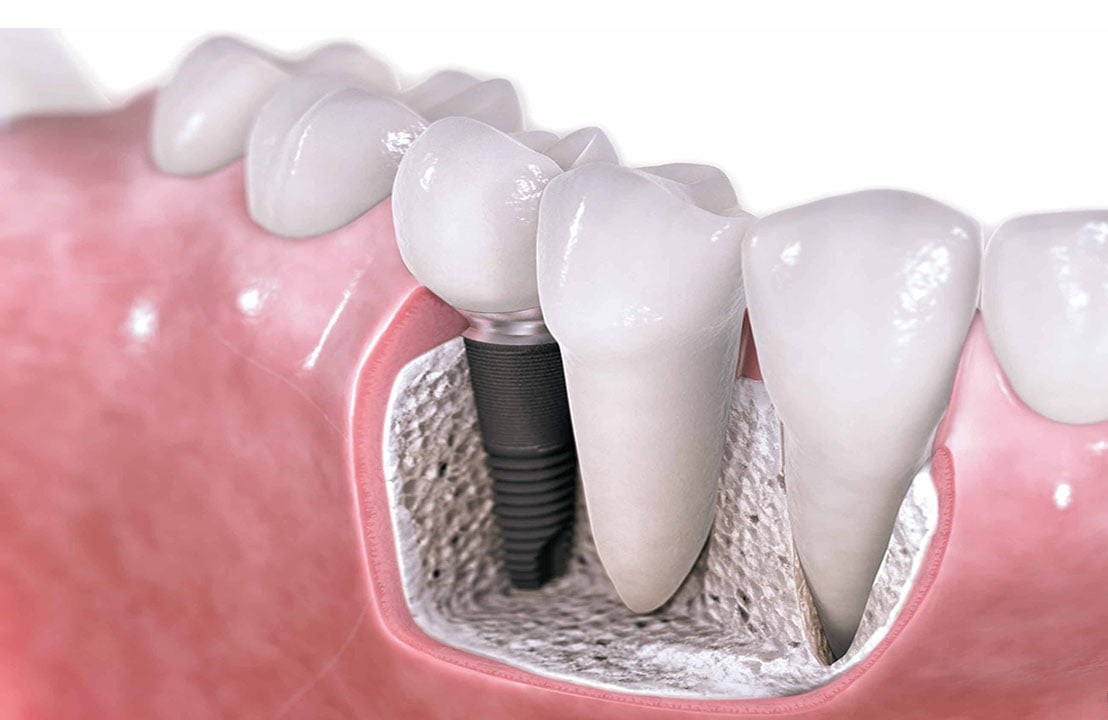 Est-ce que les implants dentaires sont faits pour vous?