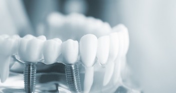 Why Should You Get Dental Implants? Dental Implants
