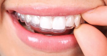 What Not To Do While Wearing Braces Braces Ottawa