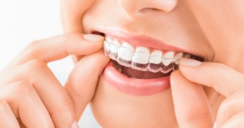 Why Invisible Braces are Popular among Teenagers Invisible Braces